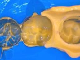 Possible problems, causes and solutions when taking dental impression of silicone rubber