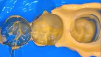 Possible problems, causes and solutions when taking dental impression of silicone rubber